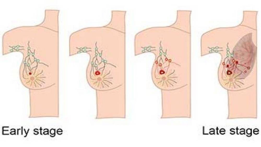 انجام غربالگری سرطان سینه