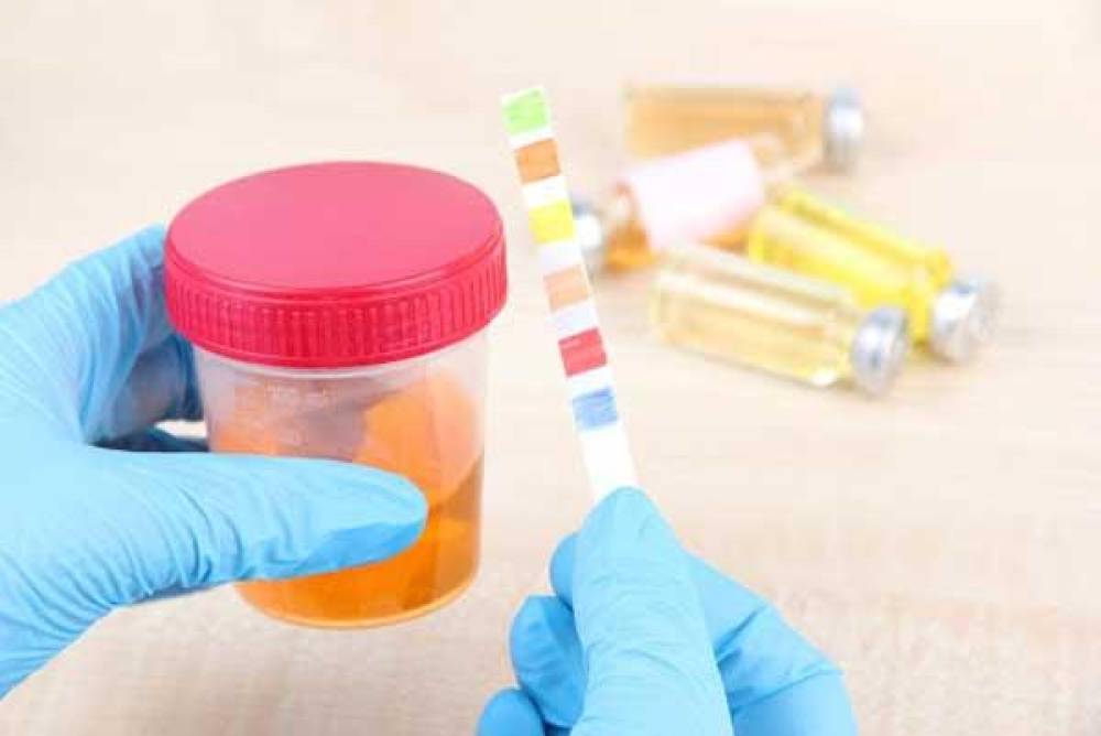 راهنمای جمع آوری ادرار در خانم ها و آقایان 